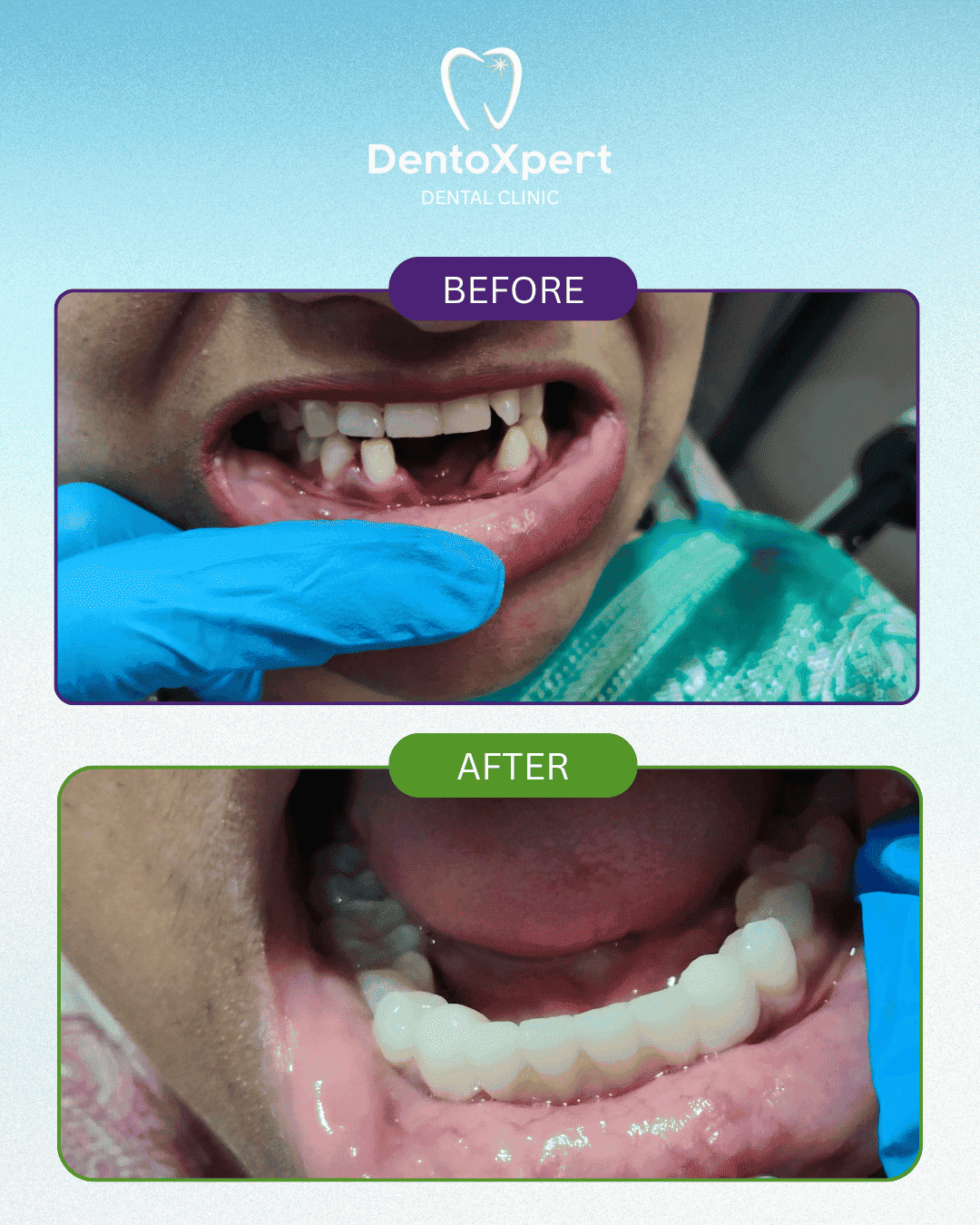 Before and after dental treatment result at DentoXpert Dental Clinic in Thane